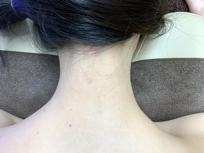 tsubakiclinic-hair-loss