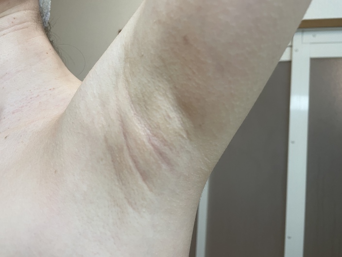 underarm-botox-after-3days-left