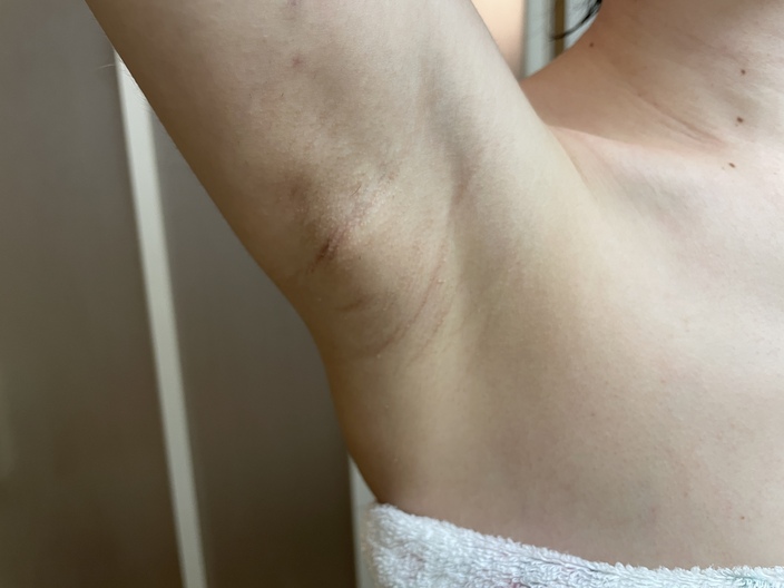 underarm-botox-after-3days-right
