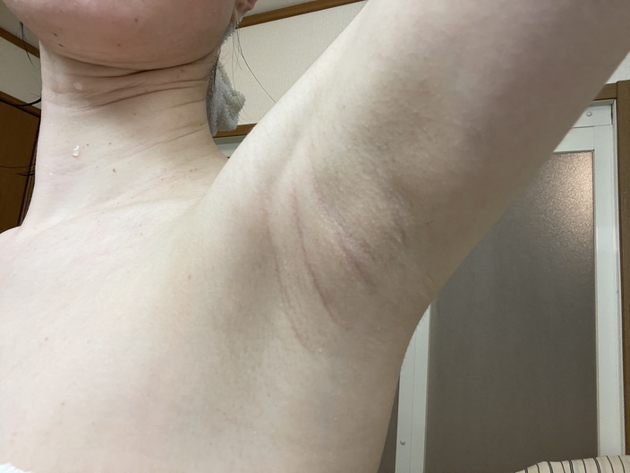 underarm-botox-after-5days-left