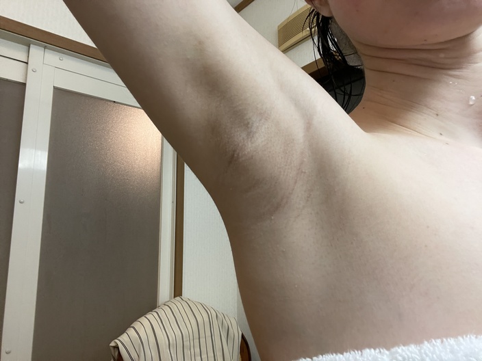 underarm-botox-after-5days-right