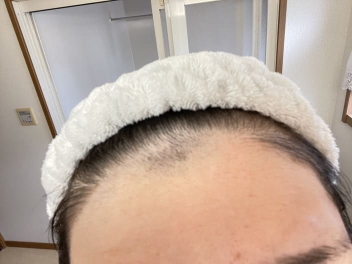 hairline-datsumou-after-2weeks